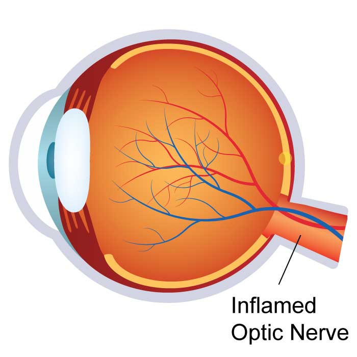 Optic Neuritis / Neuropathy