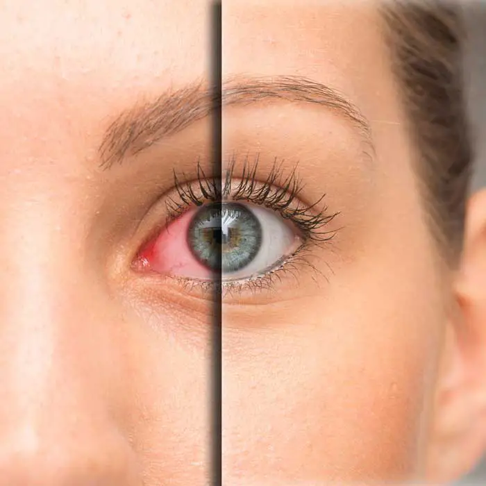 Dry Eye Relief From Our Dry Eye Clinic