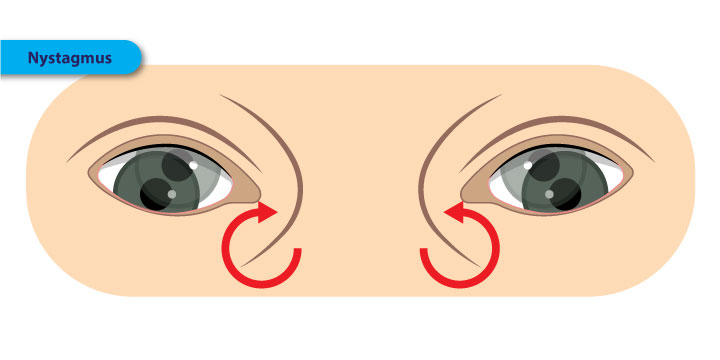 Nystagmus - Symptoms, Causes and Treatment