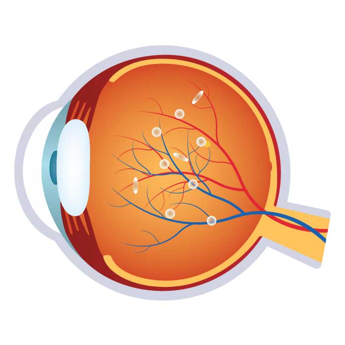 Eye Emergency - Flashes and Floaters