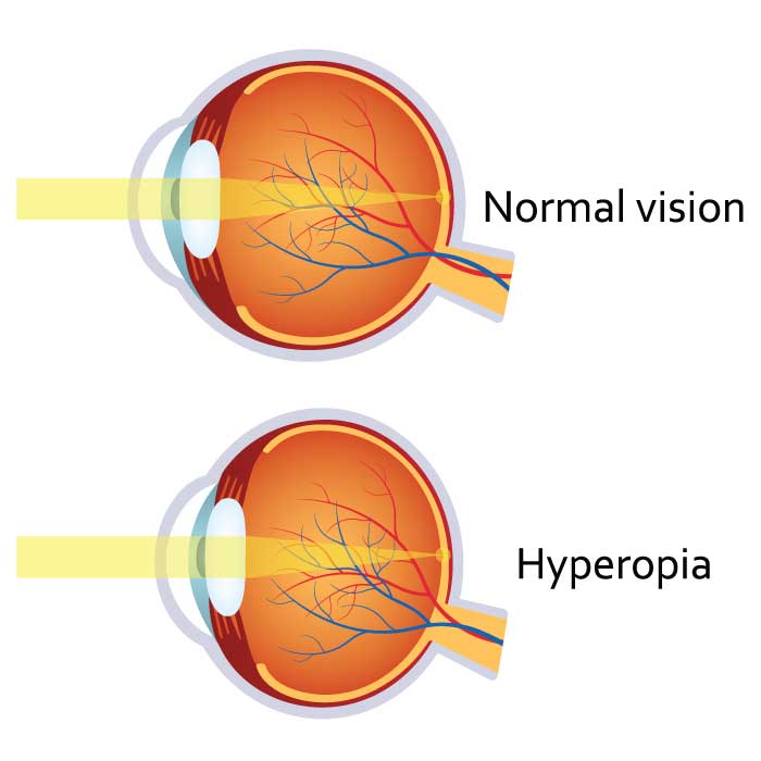 Hyperopia (Farsightedness)