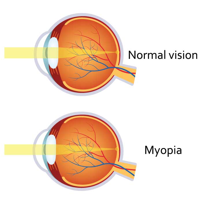 Myopia (Nearsightedness)
