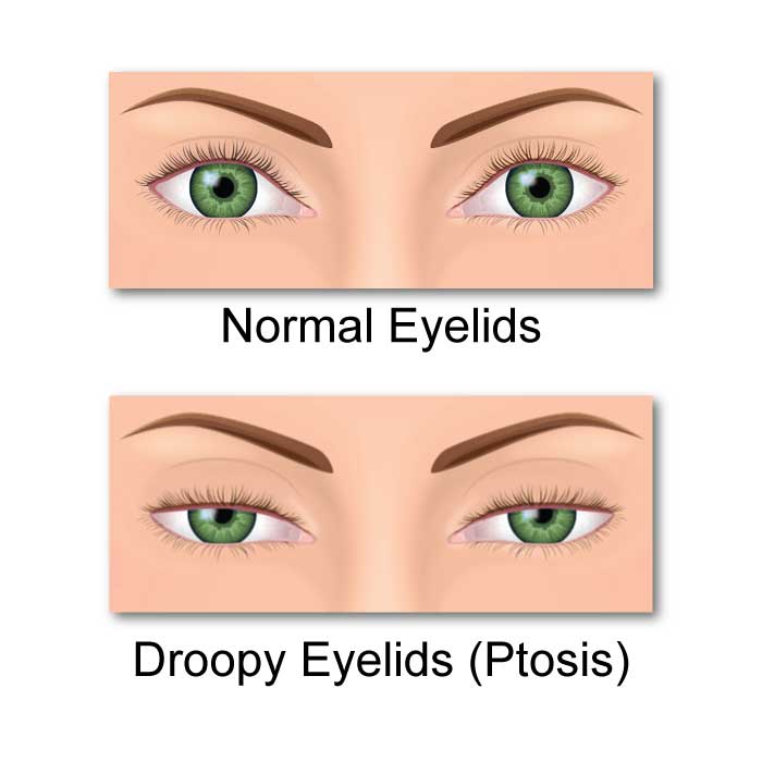 Ptosis (Drooping Eyelids)