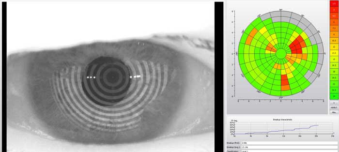 Contact Lens Dry Eye Assessment