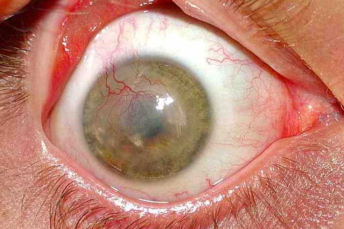 Contact Lens Exam: Check For Corneal Neovascularization