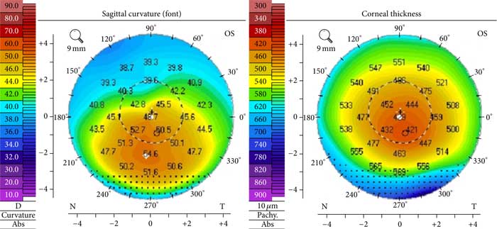 Corneal Topography - Mapping the Surface of the Eye