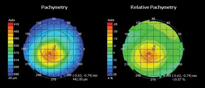 Our Edmonton Eye Exams - Pachymetry: measuring corenal thickness