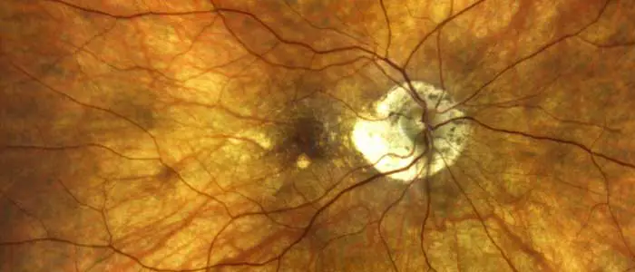 Our Edmonton Eye Exams - Retinal Imaging: a detailed snapshot of the retina