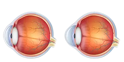 Scleral Contact Lenses Diagram