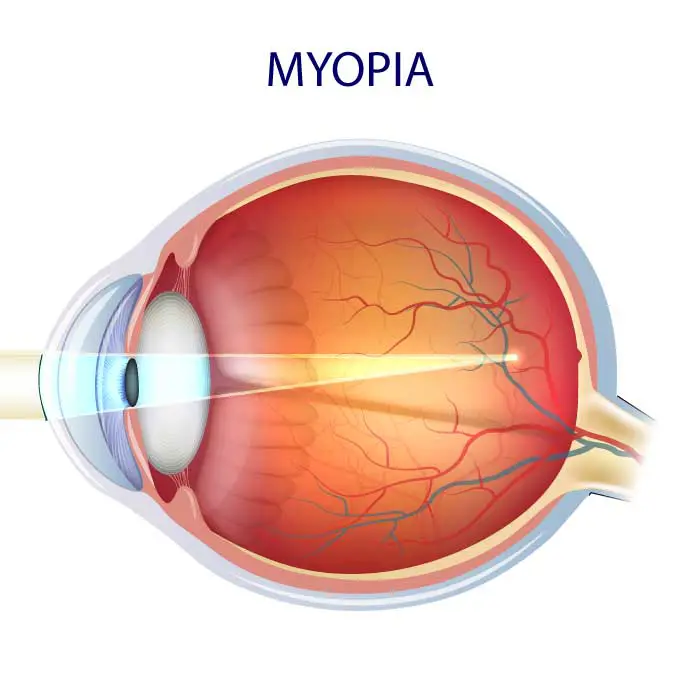 Myopia (Nearisghtedness) - Light Focusing In Front of Retina