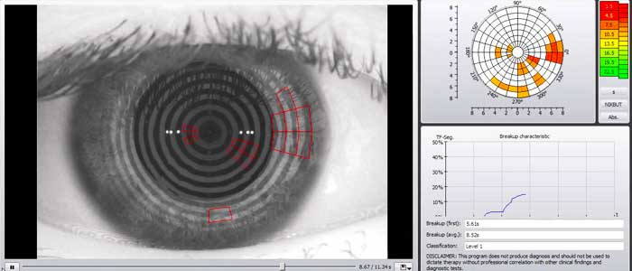 Eye Exams: Dry Eye Testing - tear film analysi