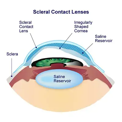 Scleral Contact Lenses Diagram