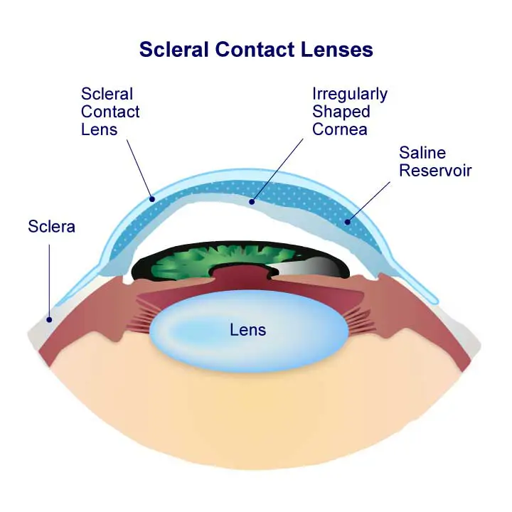 Scleral Contact Lenses Diagram