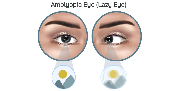 Amblyopia (Lazy Eye) - Symptoms, Causes and Treatment