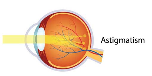 Astigmatism is an eye condition causing refractive error