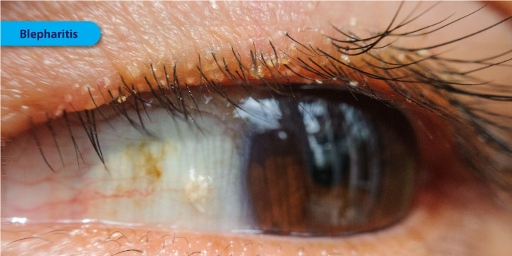 Blepharitis - Symptoms, Causes and Treatment