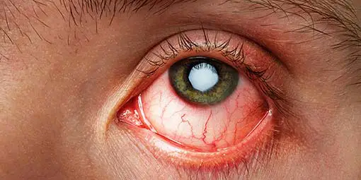 The Top Causes Of Itchy Eyes