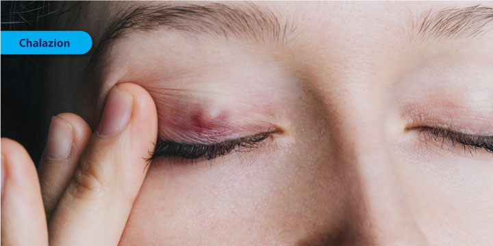 Chalazion - Symptoms, Causes and Treatment