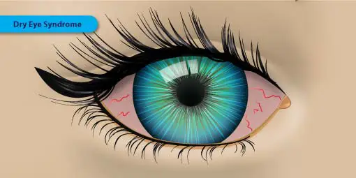 Dry Eye Syndrome - Symptoms, Causes and Treatment