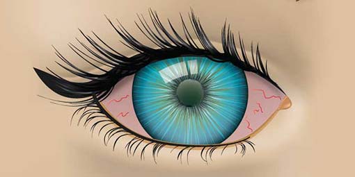 Dry Eye Syndrome or Keratoconjunctivitis sicca