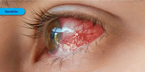Keratitis - Symptoms, Causes and Treatment