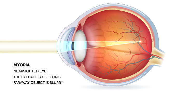 Myopia - Symptoms, Causes and Treatment
