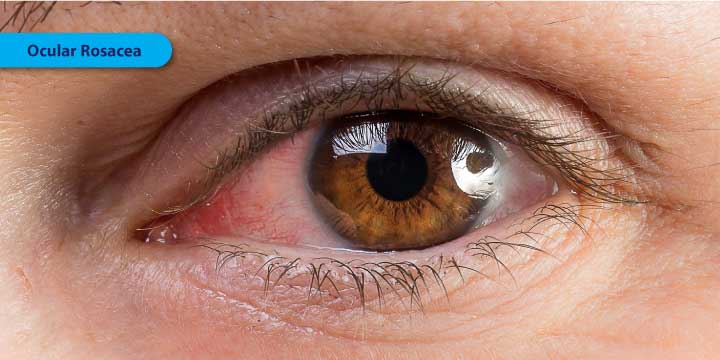 Ocular Rosacea - Symptoms, Causes and Treatment