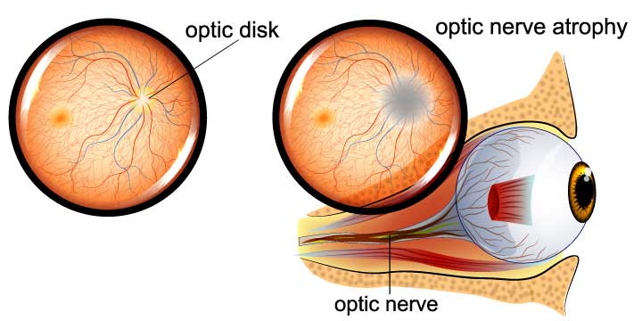 Optic Atrophy - Symptoms, Causes and Treatment