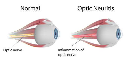 Optic Neuritis - Symptoms, Causes and Treatment | FYEyes