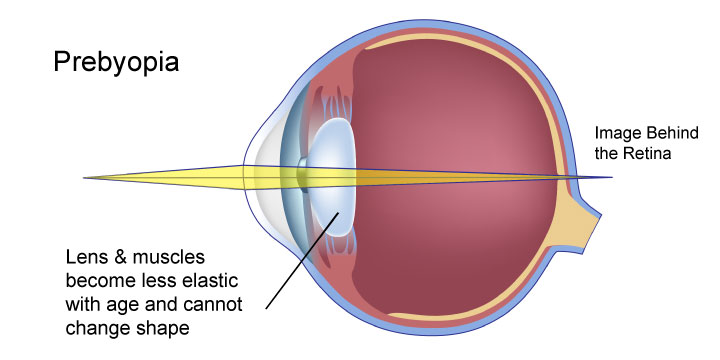 Presbyopia - Symptoms, Causes and Treatment