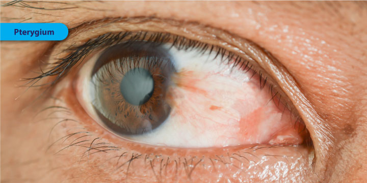 Pterygium - Symptoms, Causes and Treatment
