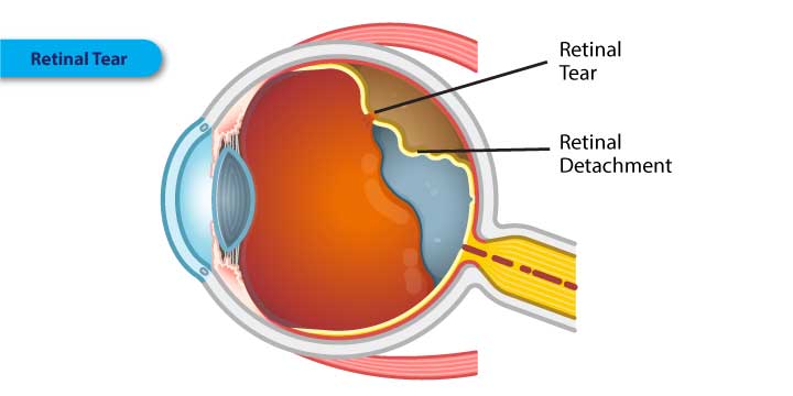 Retinal Tear - Symptoms, Causes and Treatment
